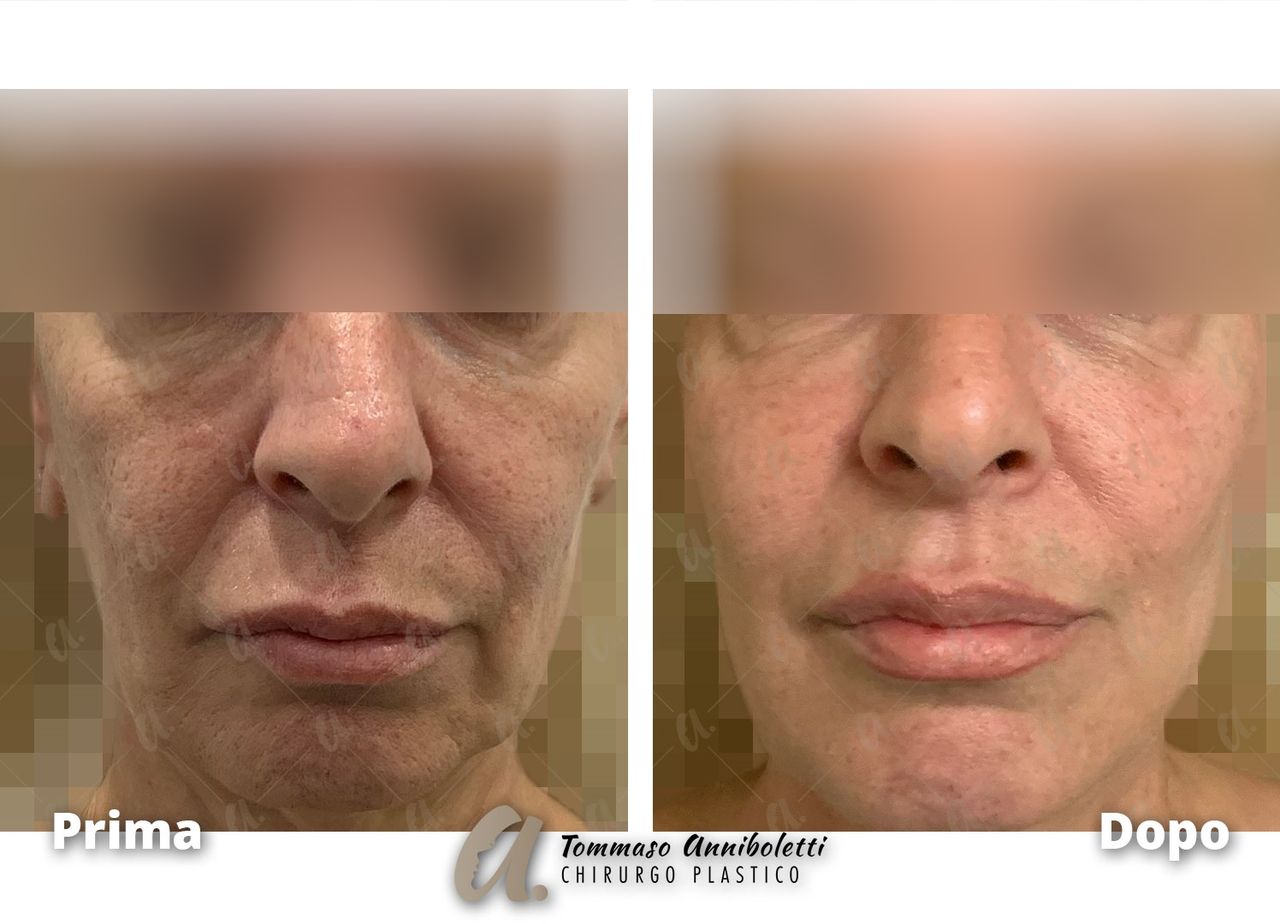 Tommaso Anniboletti-39