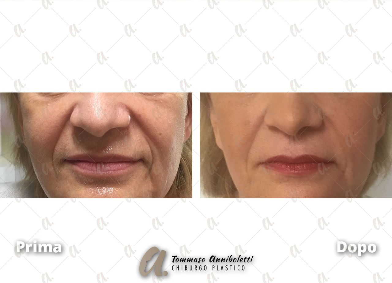 Tommaso Anniboletti-53