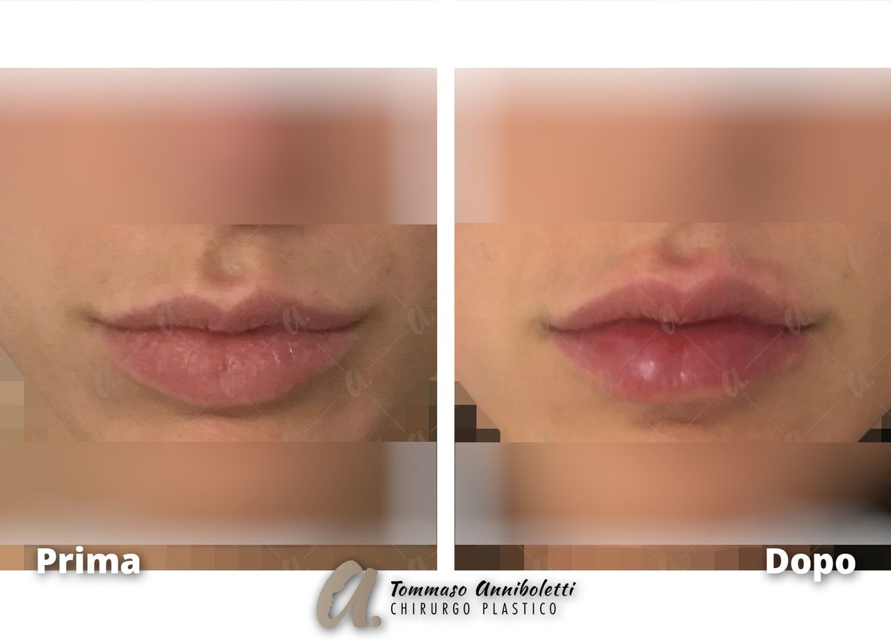 Tommaso Anniboletti-45