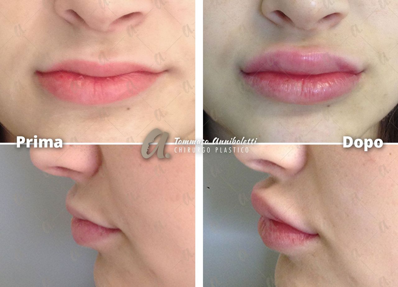 Tommaso Anniboletti-41