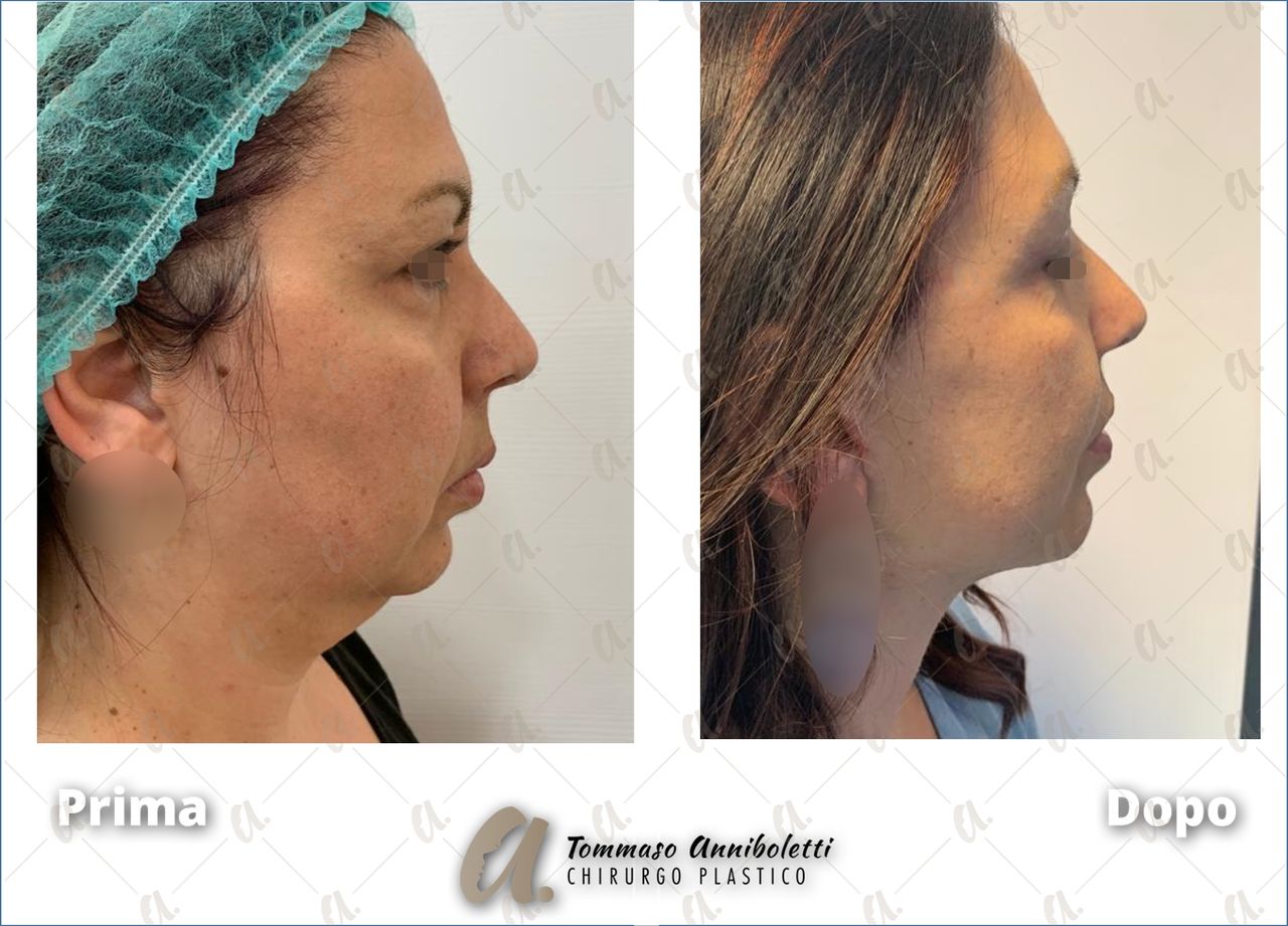 Tommaso Anniboletti-35