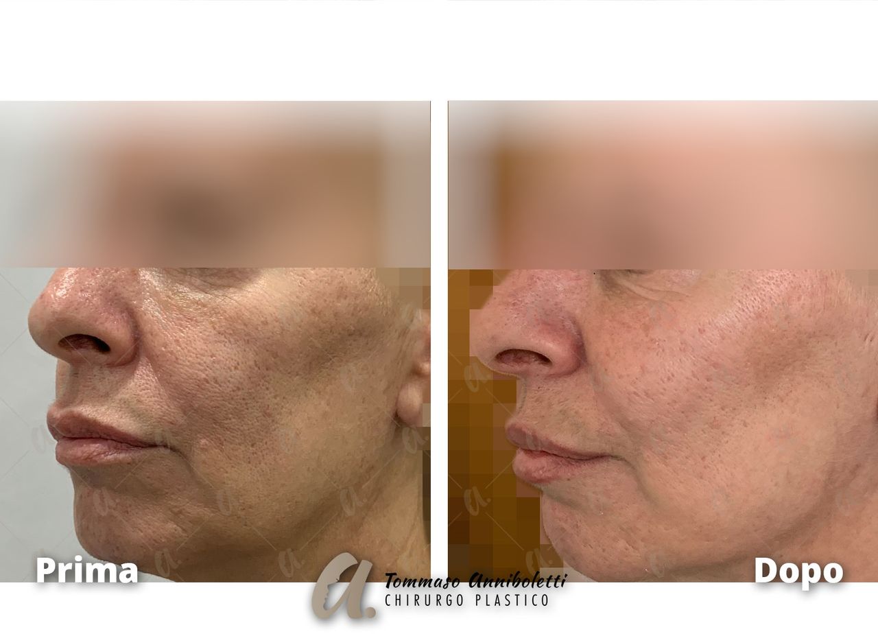 Tommaso Anniboletti-40