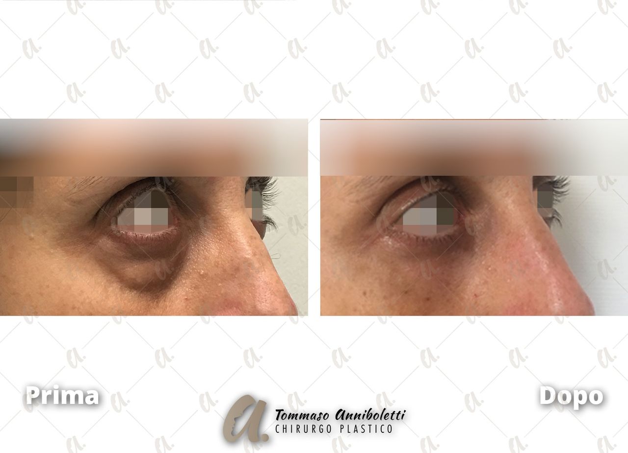 Tommaso Anniboletti-31