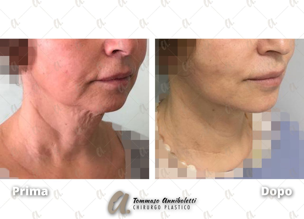 Tommaso Anniboletti-47