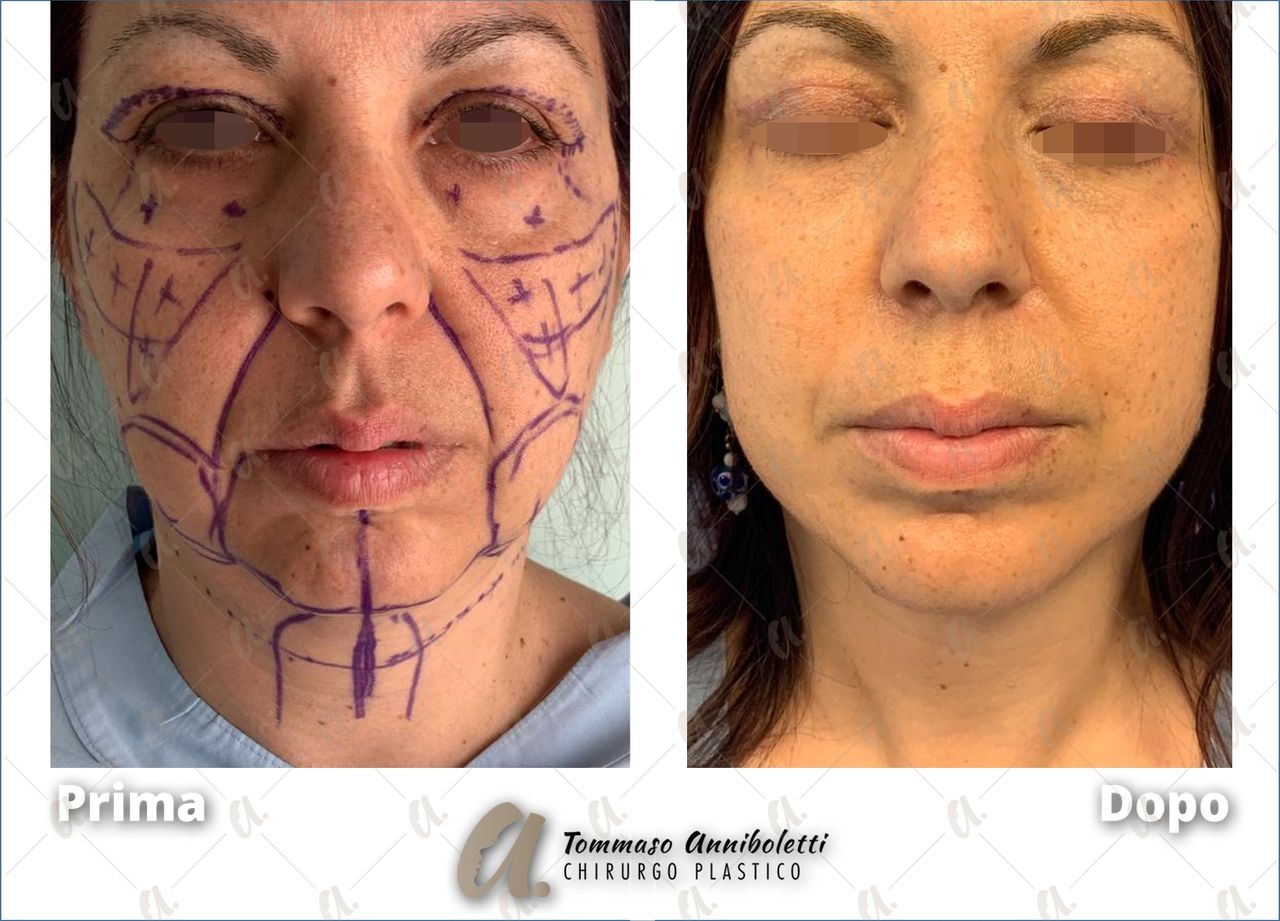 Tommaso Anniboletti-34