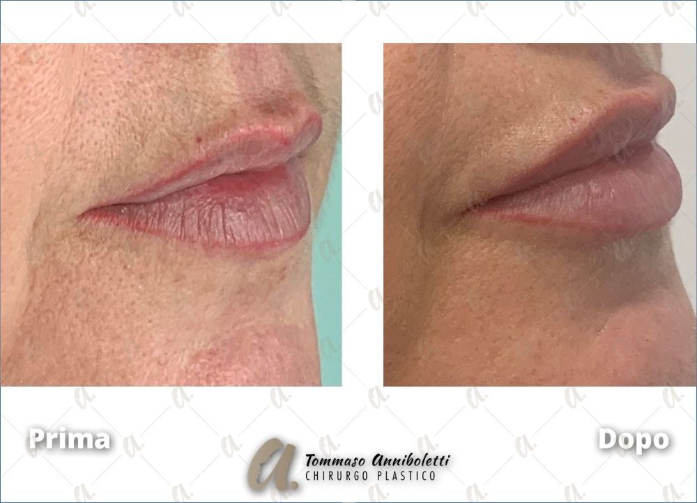 Tommaso Anniboletti-38