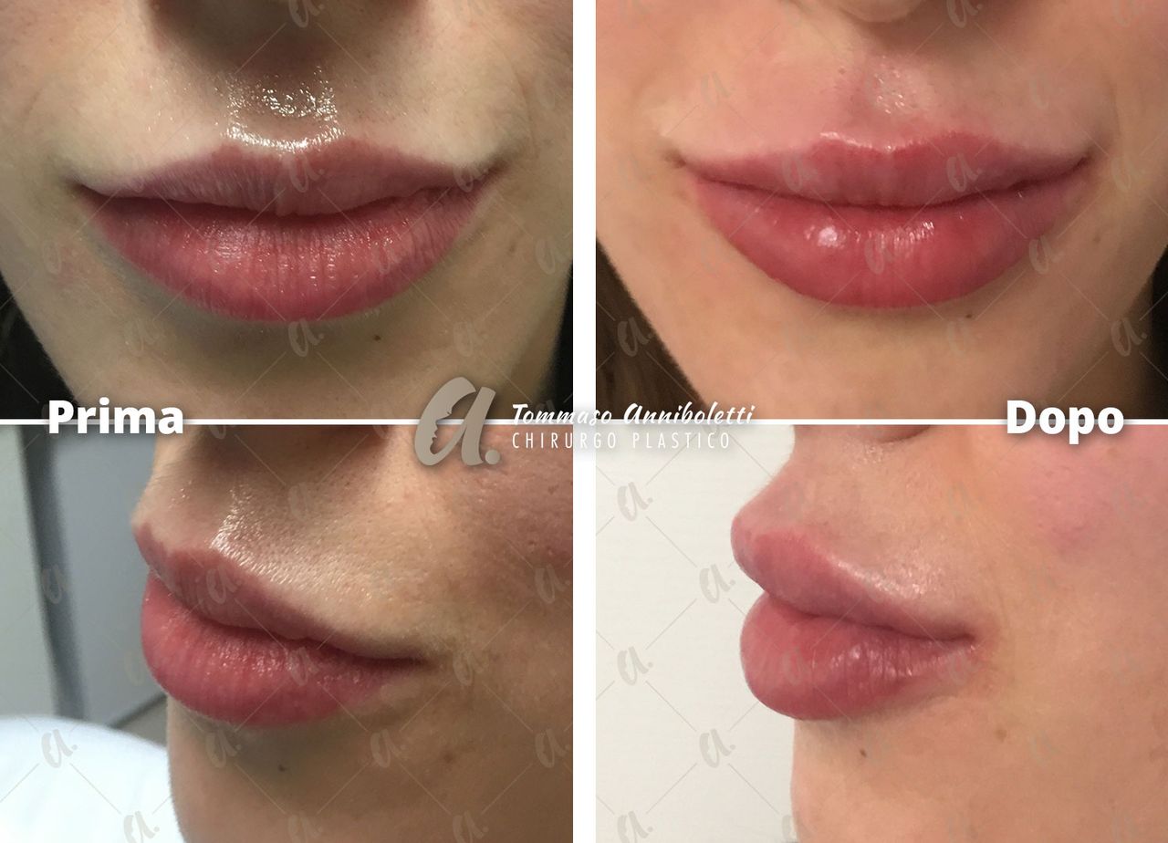 Tommaso Anniboletti-43